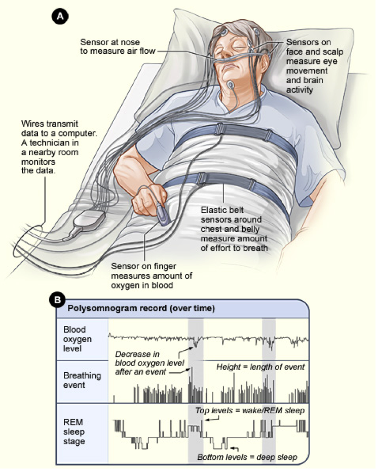 Sleep Apnea Diagnosis - Bloor Dental Health Centre Toronto