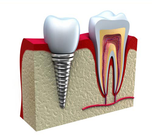 Cosmetic Dentistry Bloor, Dental crowns in Toronto