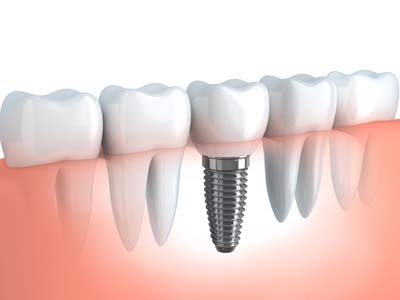 Dental Implants - bloor dental toronto