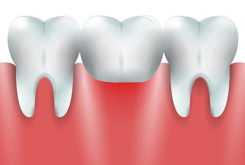 Dental Bridges - Cosmetic Dentistry Bloor - Toronto dentist - Bloor Dental Health