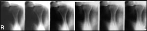 FRONTAL TMJ TOMOGRAM TORONTO