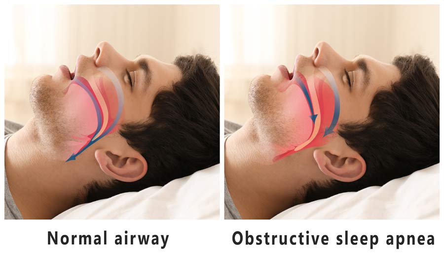 Sleep Apnea - Bloor Dental Health Centre Toronto